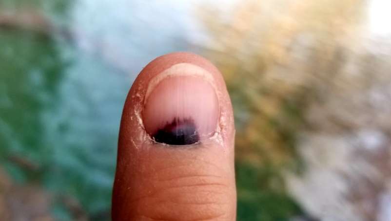Comment Diagnostiquer Un M lanome Sous L Ongle FBRYU Comment Diagnostiquer Un M lanome Sous L Ongle FBRYU