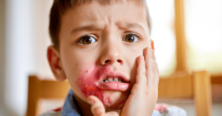 Abcès et problèmes dentaires chez l’enfant : faut-il s’inquiéter ?