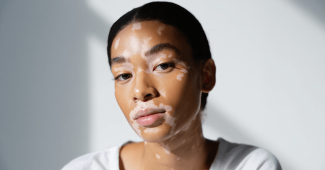Vitiligo : pourquoi la peau perd-elle sa pigmentation ?