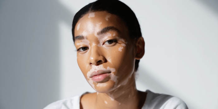 Vitiligo : pourquoi la peau perd-elle sa pigmentation ?