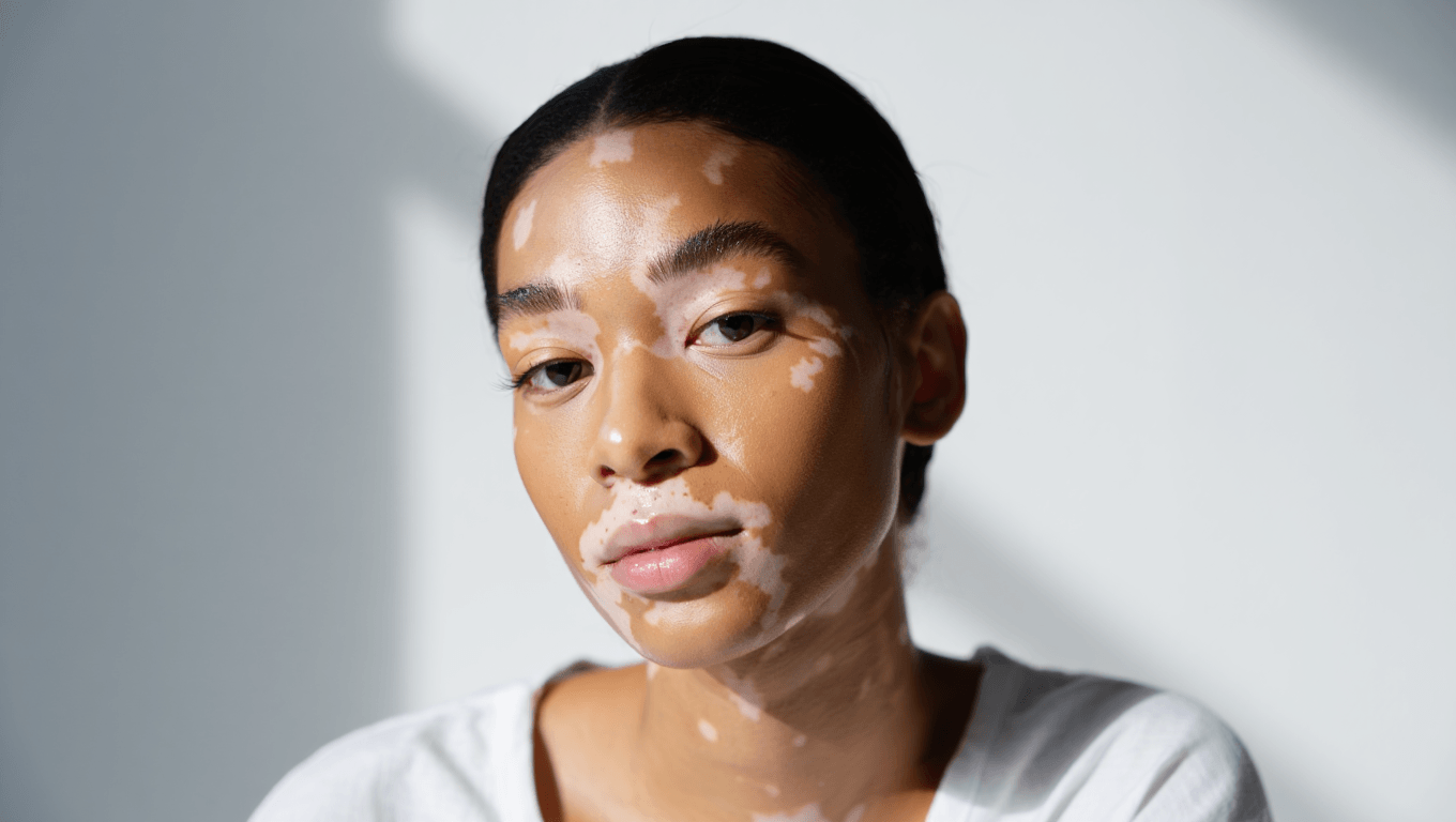 Vitiligo : pourquoi la peau perd-elle sa pigmentation ?