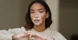 Vitiligo : pourquoi la peau perd-elle sa pigmentation ?