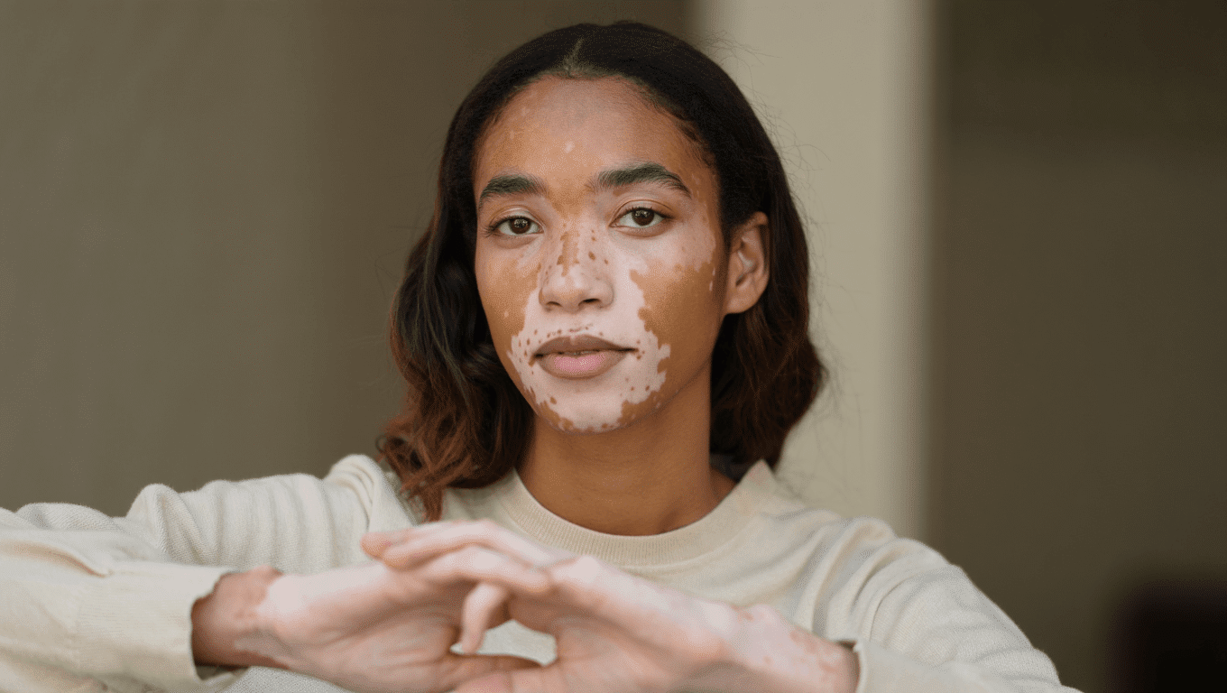 Vitiligo : pourquoi la peau perd-elle sa pigmentation ?