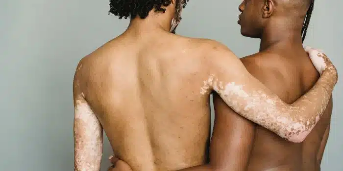 Patches de dépigmentation cutanée montrant le contraste entre la peau saine et les zones blanches du vitiligo.