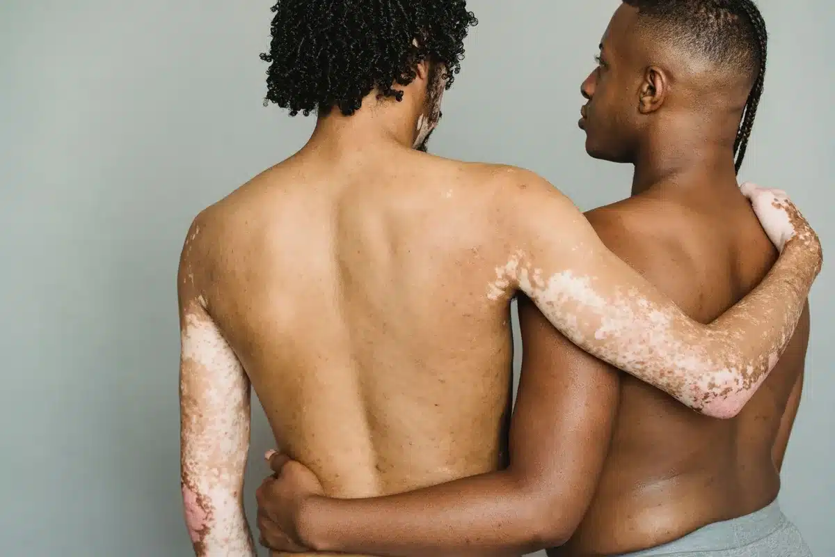 Patches de dépigmentation cutanée montrant le contraste entre la peau saine et les zones blanches du vitiligo.