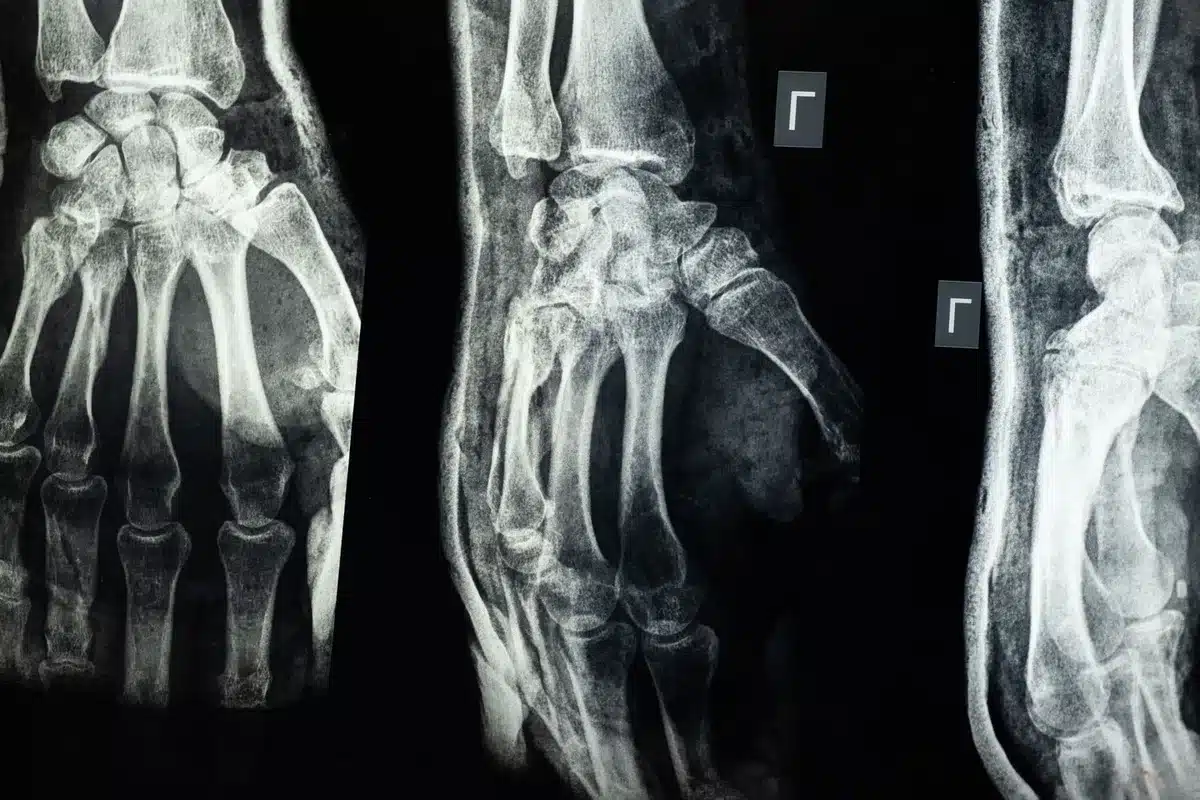Radiographie d'une jambe d'enfant montrant l'architecture osseuse et l'alignement