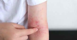 Qu'est-ce qui provoque la dermatite atopique ? Ginad.org