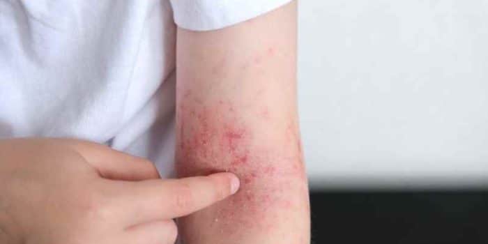 Qu'est-ce qui provoque la dermatite atopique ? Ginad.org