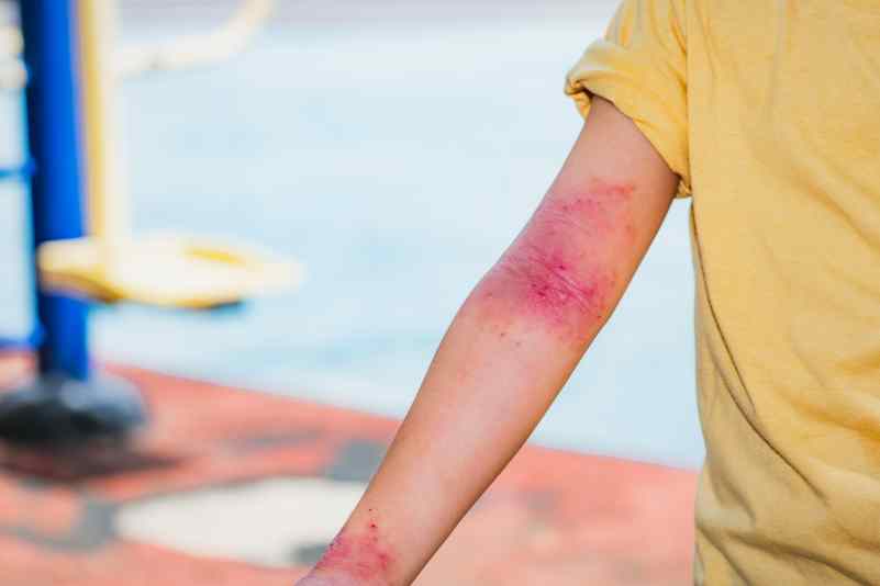 Quelles sont les causes de la dermatite atopique ? Ginad.org Quelles sont les causes de la dermatite atopique ? Ginad.org