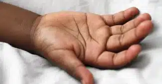 Taches de dépigmentation visibles sur la peau, illustrant les plaques caractéristiques du vitiligo