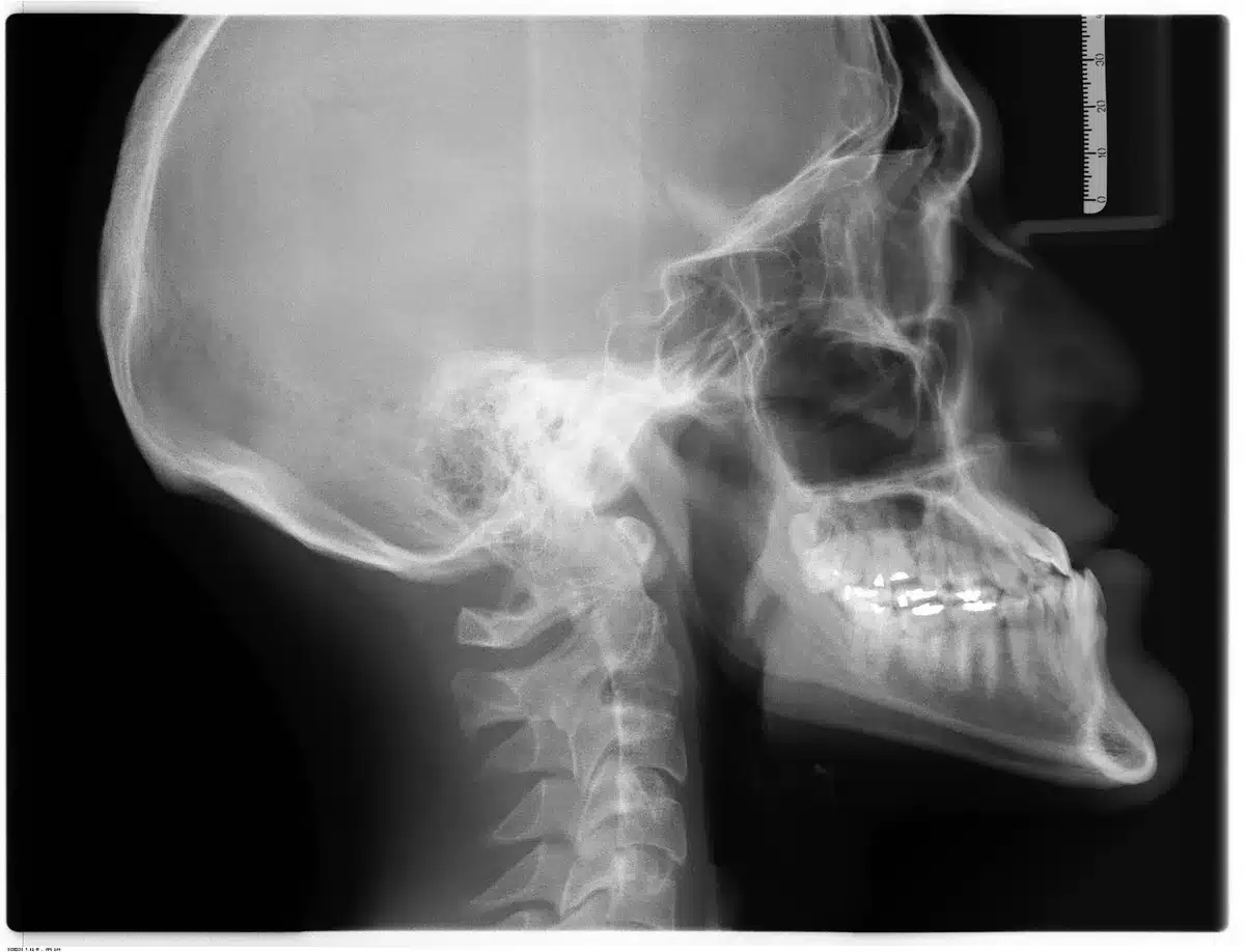 Radiographie osseuse et documents médicaux utilisés pour évaluer la minéralisation
